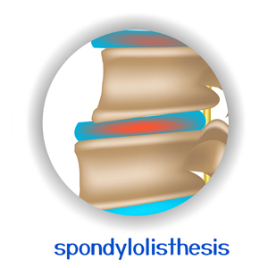 image of Richmond chiropractic spondylolisthesis